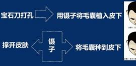 被骗用已经淘汰的宝石刀做植发怎么办?它会伤害自身毛囊吗?