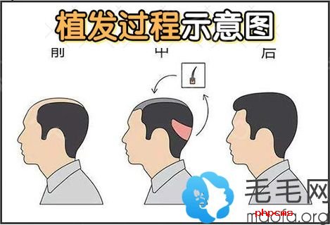 植发手术过程示意图