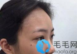 如何让发际线慢慢变低?1.5万做发际线种植效果秒杀那些窍门