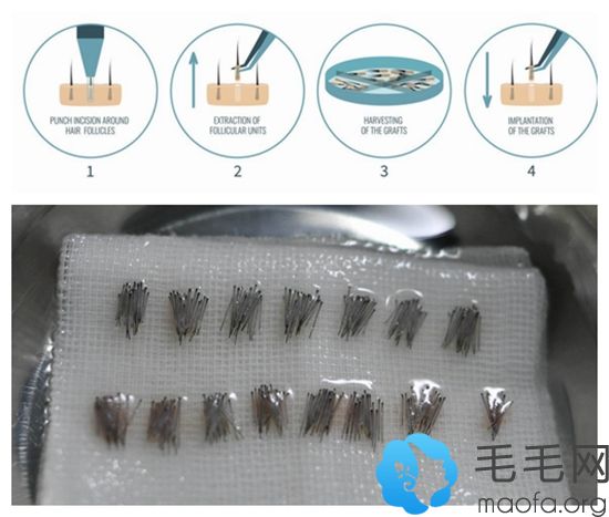 毛发移植的详细操作过程
