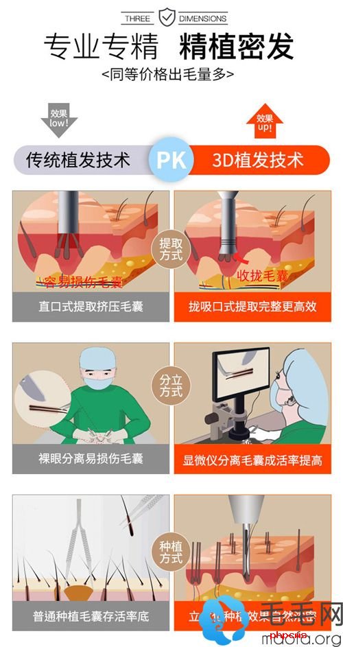 新生3D植发技术优势，取发量多20%