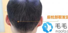 植發(fā)后應(yīng)激性脫發(fā)怎么辦？取發(fā)區(qū)應(yīng)激性脫發(fā)能恢復(fù)嗎？