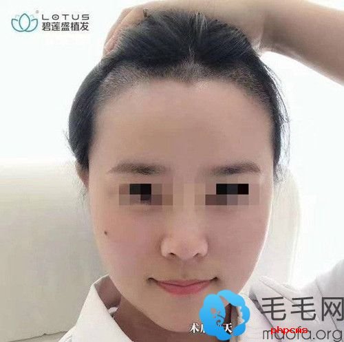 女士美人尖发际线植发10天效果