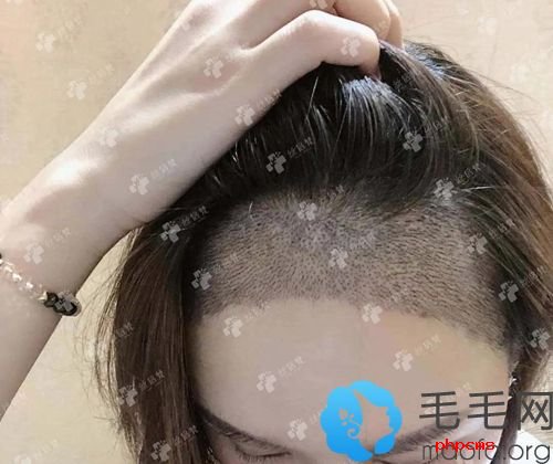 女生发际线植发三千单位效果图