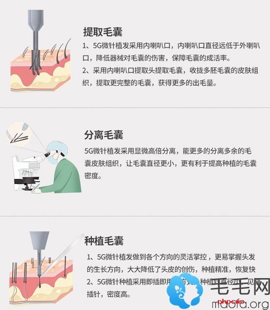 深圳青逸5G微针植发技术优势