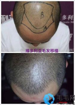 你看东莞维多利亚的植发对比案例能说明它是正规医院吗？