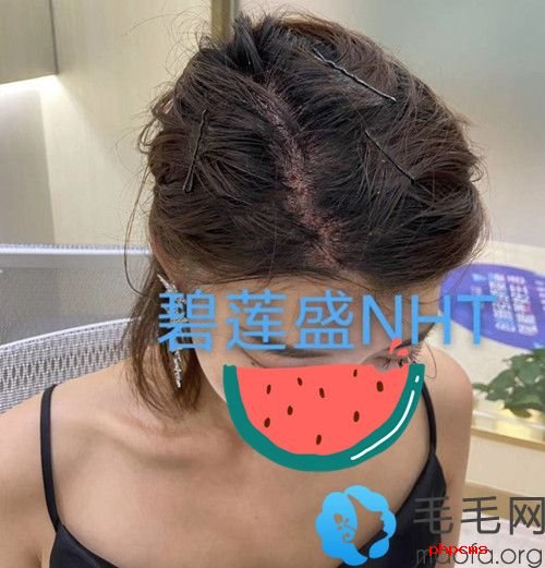 碧莲盛女士头顶加密植发案例