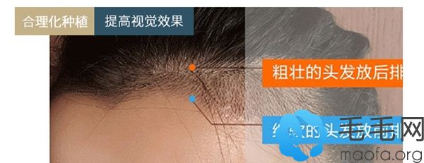 擅长个性毛发移植定制