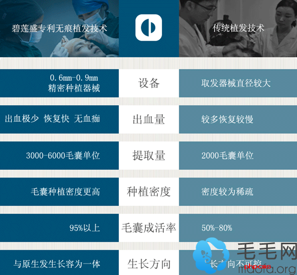 碧莲盛SHT技术植发的优势