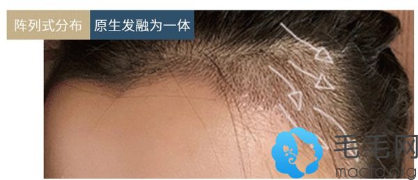 李医生种植效果自然浓密