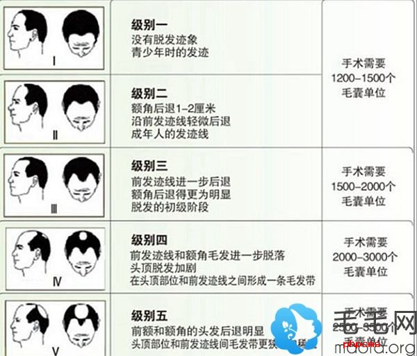 发际线毛囊种植等级图