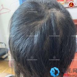 我花1万多在杭州做的斑秃植发有较好效果,且不担心还会再掉