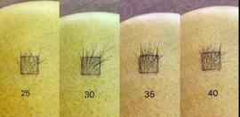 種1000根頭發(fā)有多大面積?怎么這些碧蓮盛的植發(fā)案例還不一樣
