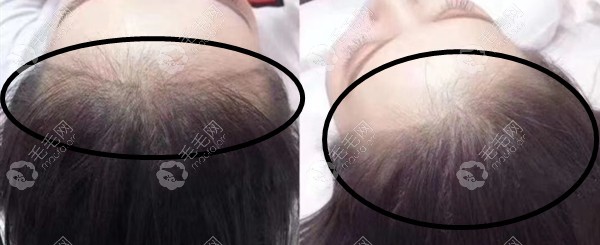可再生发际线术后即刻效果