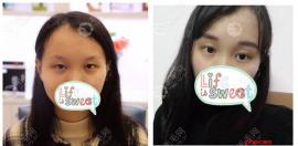 【扒皮】成都植眉好的医院名单及眉毛种植价格/真实对比图