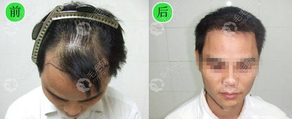 男士前额发际线种植案例