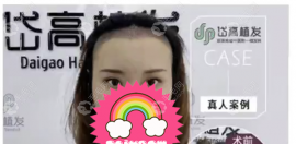發(fā)友說:長沙岱高植發(fā)靠譜且九月可享微針種植500單位3999元起