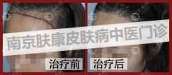 这些种植发际线的前后对比照反馈了南京肤康治脱发有一手