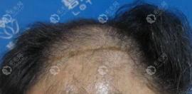 我去过碧莲盛,所以来说下青岛碧莲盛植发医院靠谱吗?