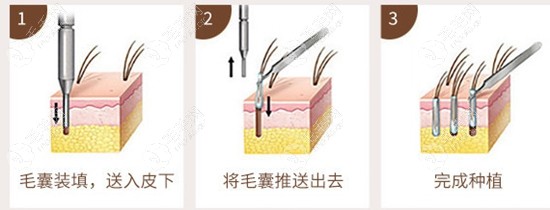 壹加壹头发种植手术过程