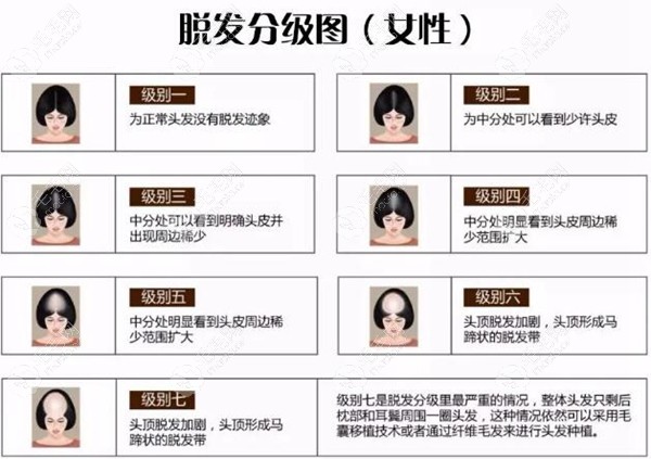 女士头顶脱发等级图