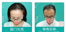 深圳青逸用5G微针技术植发际线大概需要多少?500毛囊6000元起