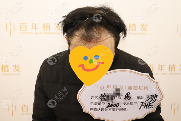 种植前额要多少根头发？在无锡百年种了2000毛囊,屌丝逆袭了