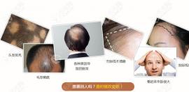 烏魯木齊植發(fā)醫(yī)院哪家好?正規(guī)醫(yī)院的植發(fā)價(jià)格貴不貴？