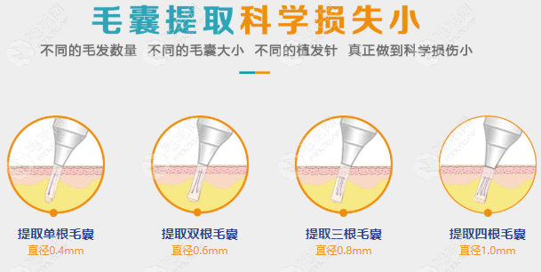 贞韩植发的不同型号的种植笔