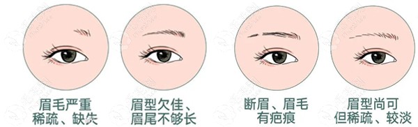 北京可以做植眉的医院有哪些?业内人分享排名及种眉毛价格