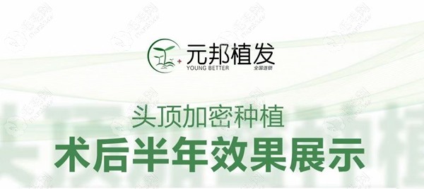 头顶加密6个月没啥效果?他找西安元邦张华医生做的还不错!