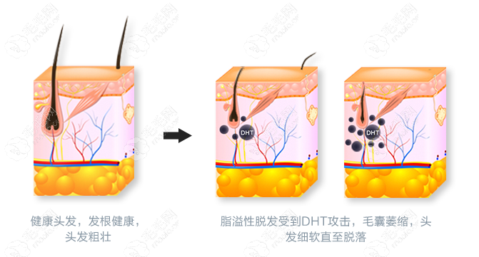 脂溢性脱发的慢过程