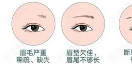 北京可以做植眉的医院有哪些?业内人分享排名及种眉毛价格