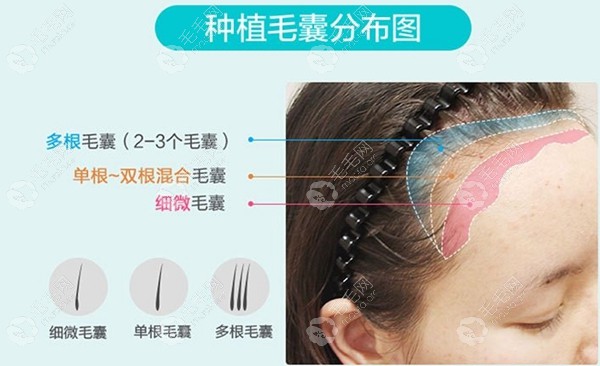 成都恒博种植发际线分布图