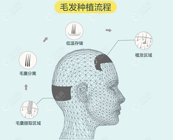 发际线移植手术流程