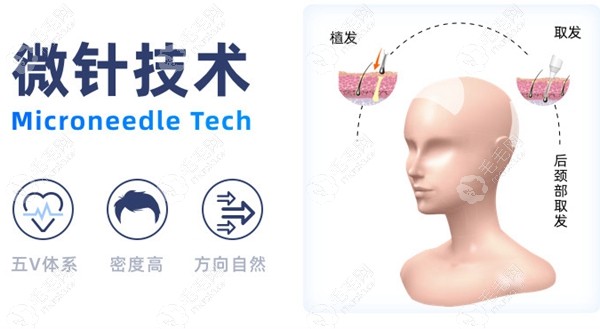 找张桥院长做SHT发际线植发2000单位多少钱?