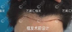 猜猜我发际线下调一厘米大概多少钱?种植了1200毛囊单位