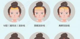 成都恒博微针植发际线500个单位的价格是多少?