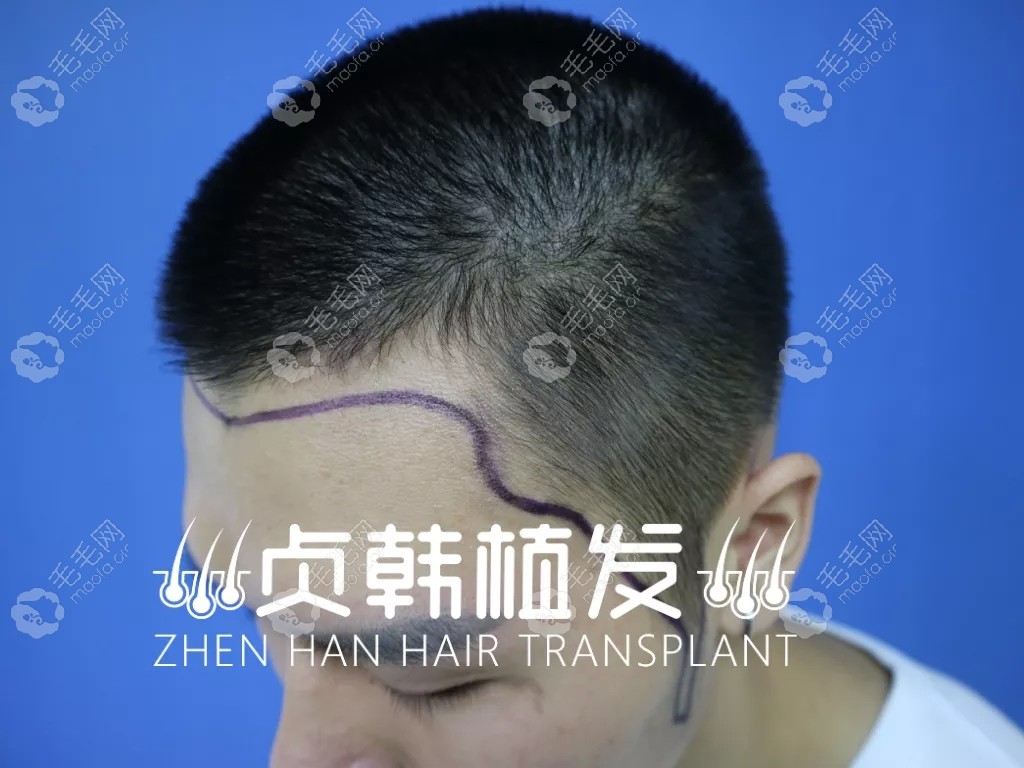 种植胡子可以保持多久？看我种胡子的效果如何,变型男了吗?