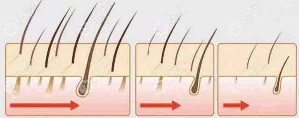 毛囊萎缩和毛囊闭合的区别