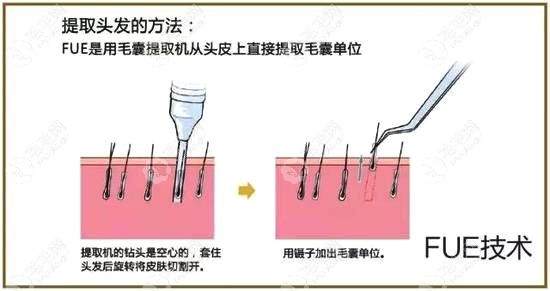 fue无痕植发技术的原理