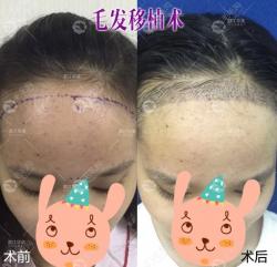 湛江华美植发行吗?不同样式的女性发际线种植案例实力见证!