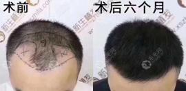 上新2020重庆植发的价格,猜猜这植发1000单位大概多少钱左右
