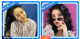 怎么样快速生发？90后选择的植发手术靠谱吗？