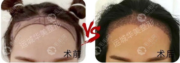 运城华美美人尖发际线种植对比效果图