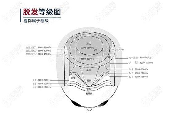 来碧莲盛看你算脱发几级了？