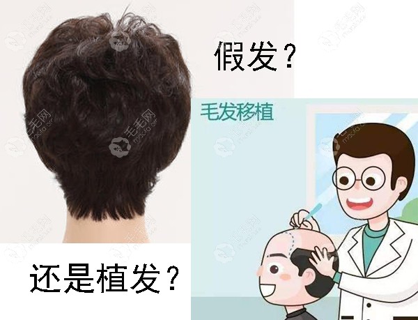 脱发应该选假发还是植发？