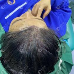 淮安微针植发第一天之女性发缝加密术后即刻效果图