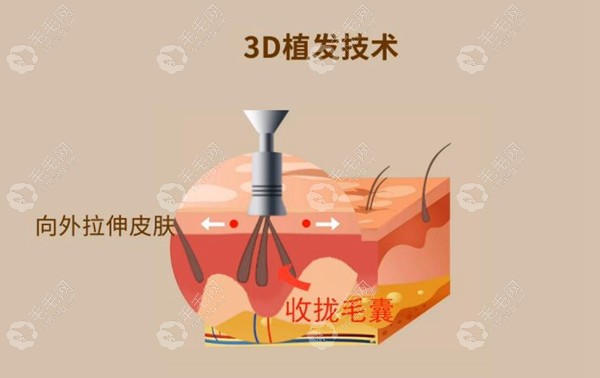 你知道3d无痕微针植发技术用的是什么仪器吗?