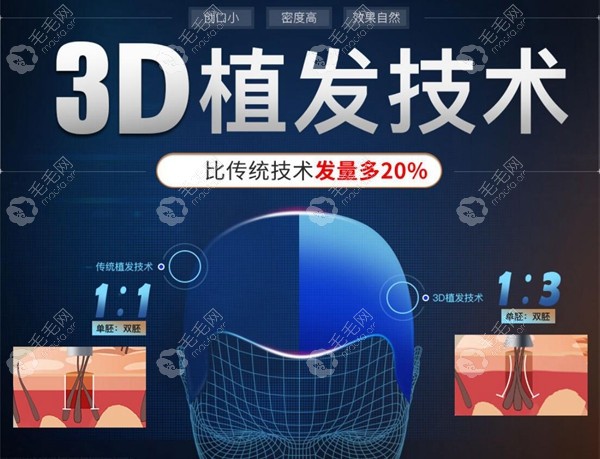 新生3d植发技术优势